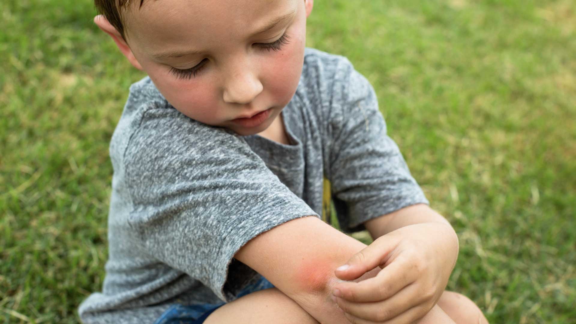 Young child with gnat bites on elbows